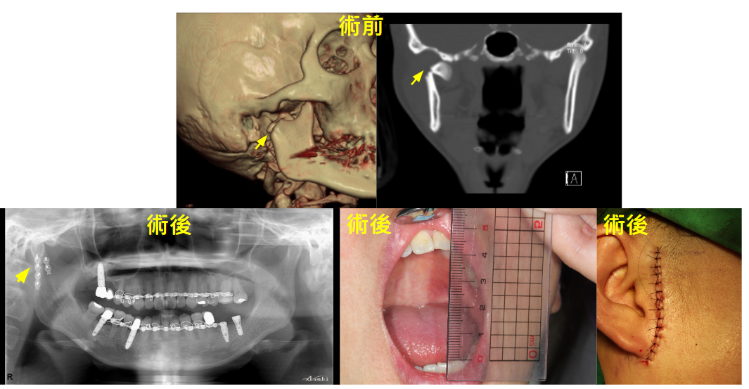 顳顎關節骨折3