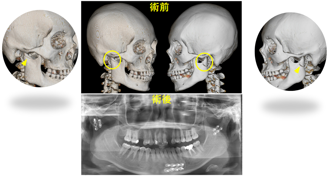 顳顎關節骨折4