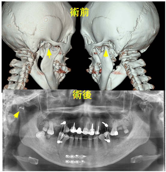 顳顎關節骨折5