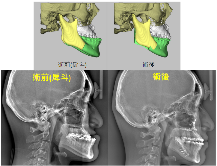 正顎手術1
